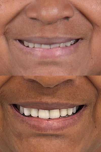 Antes e depois de uma reabilitação oral no Atelier do Dente